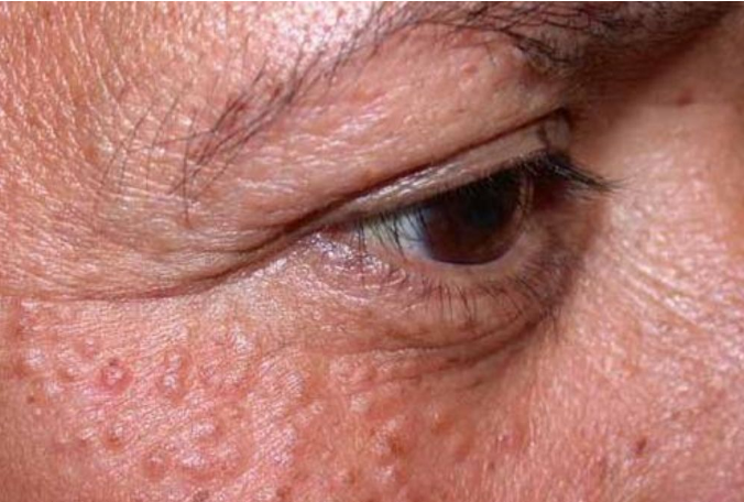 keratosis pilaris under eyes